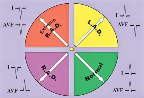 Axis deviation | Cardiology nursing, Medical knowledge, Emergency nursing