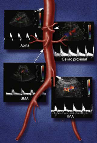 Inferior Mesenteric Artery Ultrasound