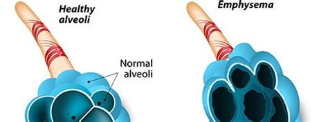 Emphysema: Causes, Symptoms And Treatment | Netmeds