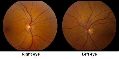 Internuclear ophthalmoplegia – Case-Based Neuro-Ophthalmology