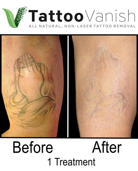 Best Tattoo Removal in Miami | All-Natural & Non-Laser Tattoo Removal