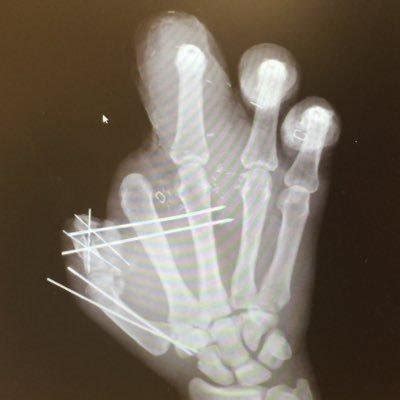 New York Giants DE Jason Pierre-Paul shows X-Ray of hand - UPI.com