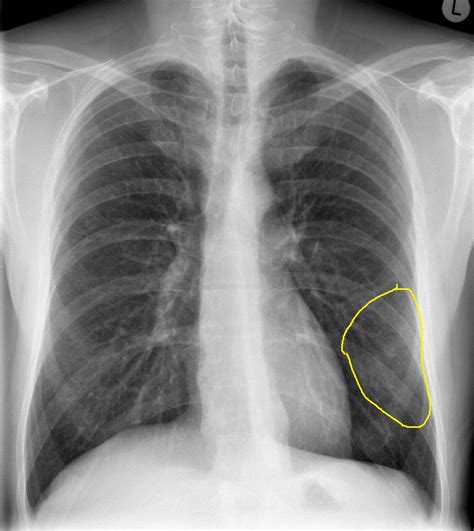 Pneumonia differential diagnosis - wikidoc