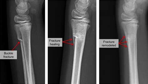 Buckle Fracture - Raleigh Hand Surgery — Joseph J. Schreiber, MD