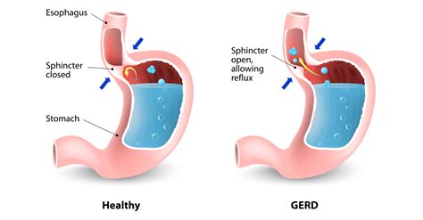 Antireflux Surgery (GERD) | Mithani MD