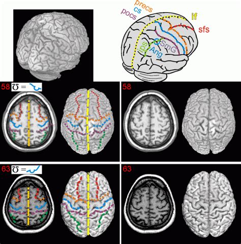 neuroanatomy atlas: finding the central sulcus and motor hand area