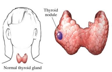 10,000 Strong Against Thyroid Cancer: Thyroid Nodules Overview