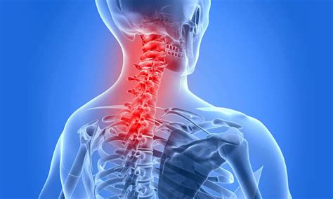 Ankylosing Spondylitis | Ankylosing spondylitis, Cervical, Disorders