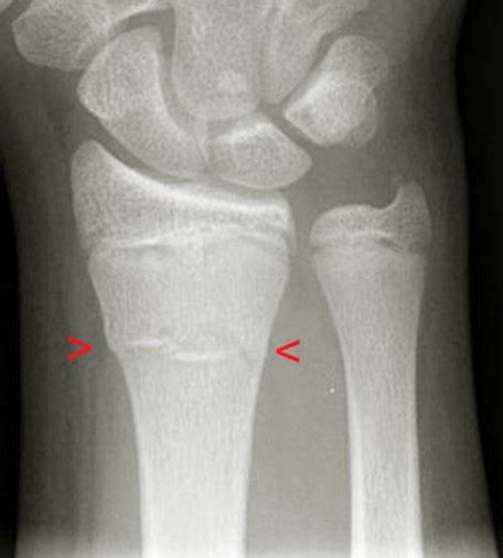 👉 Buckle Fracture - Pictures, Healing time, Treatment, Causes (February 2022)