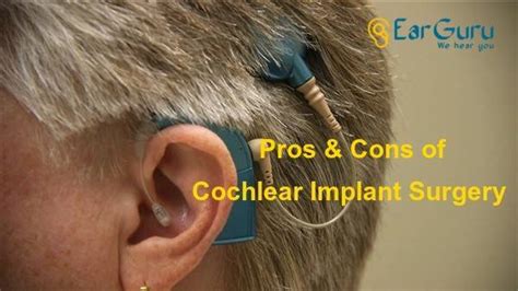 Planning a Cochlear Implant surgery? Understand the Pros and Cons