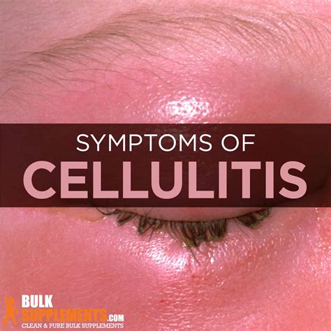 Cellulitis: Symptoms, Causes & Treatment