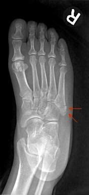 Tuberosity Of 5th Metatarsal Pain