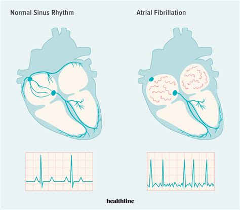 Sinus Rhythm: Normal Sinus Rhythm, Sinus Rhythm Arrhythmia