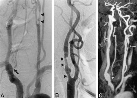 A and B, Arch aortogram (A) and selective angiogram (B) of the left ICA... | Download Scientific ...