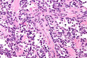 Rhabdomyosarcoma - Libre Pathology