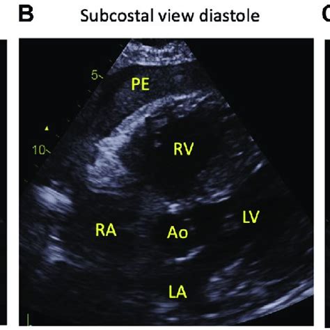 Echocardiographic images of the subcostal views of the heart chambers... | Download Scientific ...