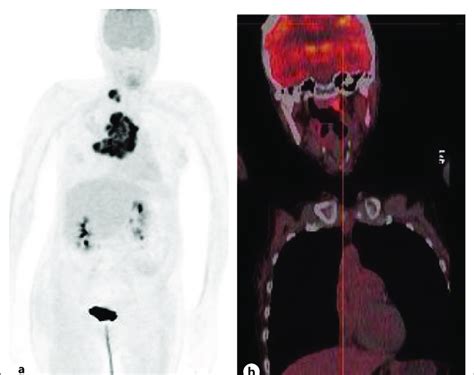 PET scans before and after treatment. a PET/CT performed prior to... | Download Scientific Diagram