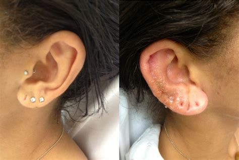 Complications of Ear Piercing: Perichondritis and Ear Disfigurement