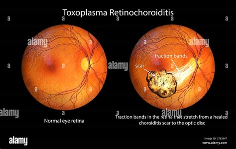 Toxoplasma retinochoroiditis, illustration Stock Photo - Alamy