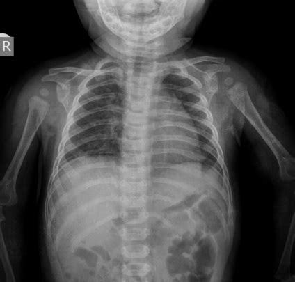 Child Chest Xray Image Stock Photo - Download Image Now - iStock