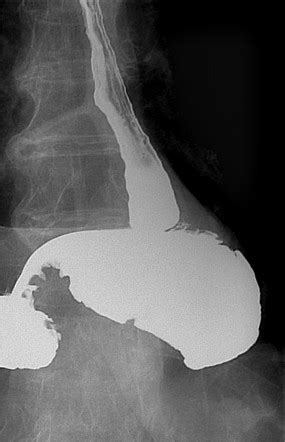 Organoaxial gastric volvulus | Image | Radiopaedia.org