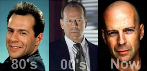 bruce-willis-hair - Anastasakis Hair Clinic