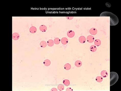 Hemolytic anemia