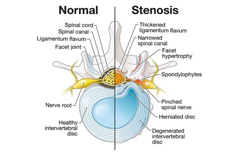 Lumbar Stenosis: Causes, Symptoms and Treatment Options for Narrowing ...