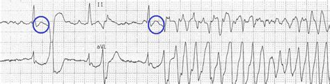 R on T phenomenon | Nclex, Medical advice, This or that questions