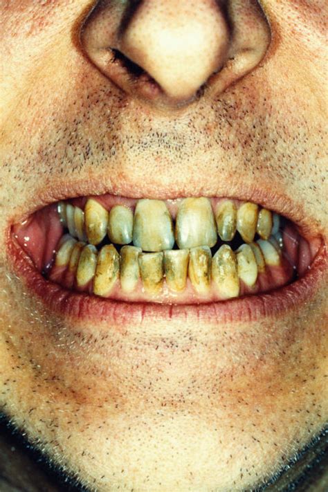 What Teeth Problems Can Tell You About Your Health - Dental Problems Can Be an Early Warning ...