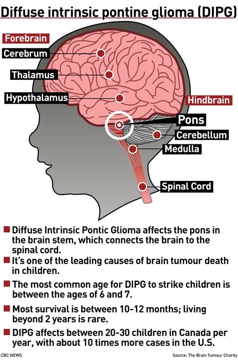 Why this rare childhood brain cancer is so difficult to fight | CBC News