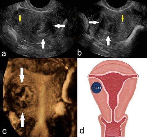 FIGO 4—intramural leiomyoma with no endometrial or subserosal contact.... | Download Scientific ...