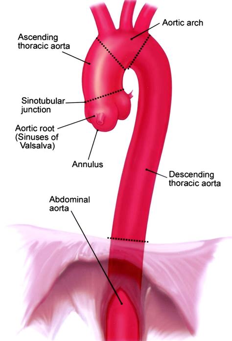 ascending aortic aneurysm | ... aorta. (©Massachusetts General Hospital ...