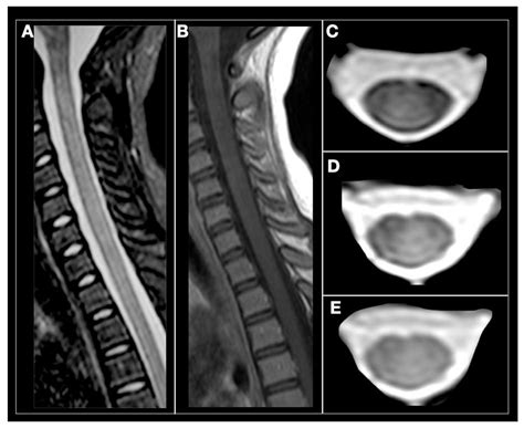 Cervical Spine Mri Ms