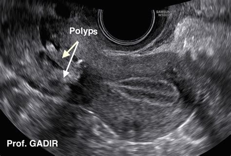 Polyps