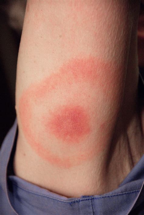 As Lyme Disease Cases Rise, Tips for Protecting Against Tick Bites | Chicago News | WTTW