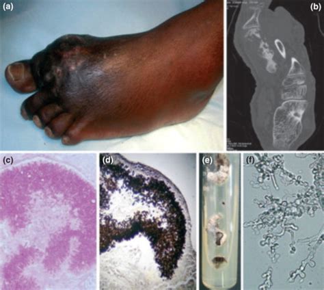 Eumycetoma caused by Diaporthe phaseolorum (Phomopsis phaseoli): a case report and a mini-review ...