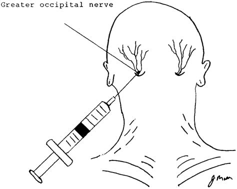 Anatomy and technique of occipital nerve block for treatment of... | Download Scientific Diagram