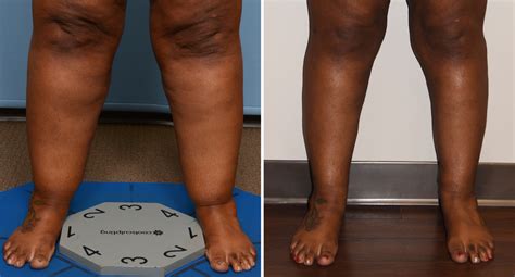 Plastic Surgery Case Study - Large Cankle Liposuction - Explore Plastic Surgery