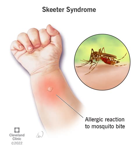 Skeeter Syndrome: Causes, Symptoms & Treatment | Flipboard