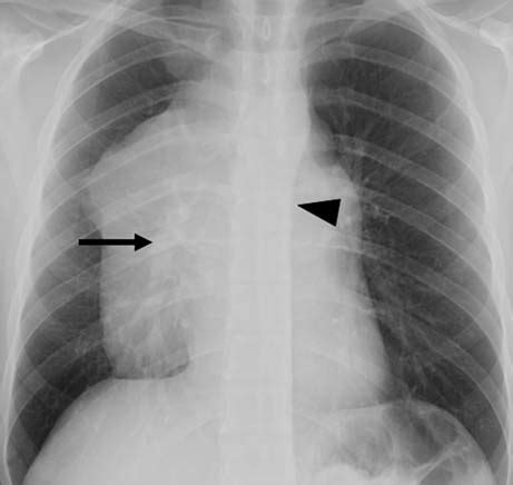 a,b Hilum overlay sign in a 29-year-old patient with lymphoma ...