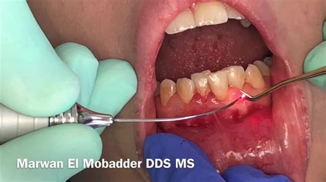 Gingival Hyperplasia Treatment