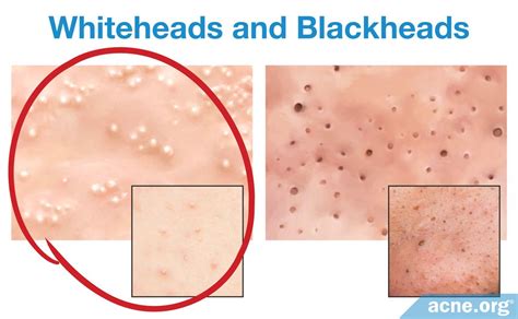 What Is a Whitehead? - Acne.org