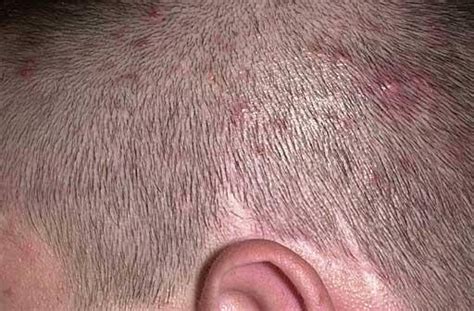 10 Home Remedies for Scalp Folliculitis - Home Remedies