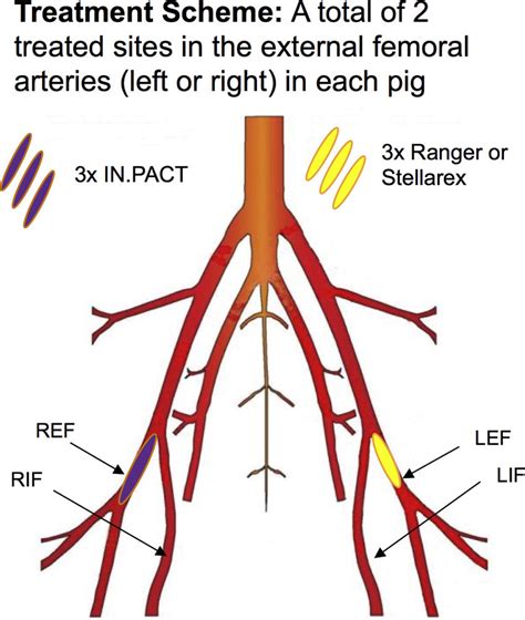 Pdf Successful Treatment Of A Superficial Femoral Artery | Images and Photos finder