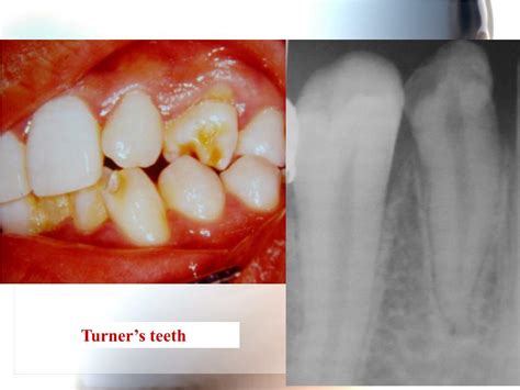 PPT - ABNORMALITIES OF TEETH PowerPoint Presentation, free download ...