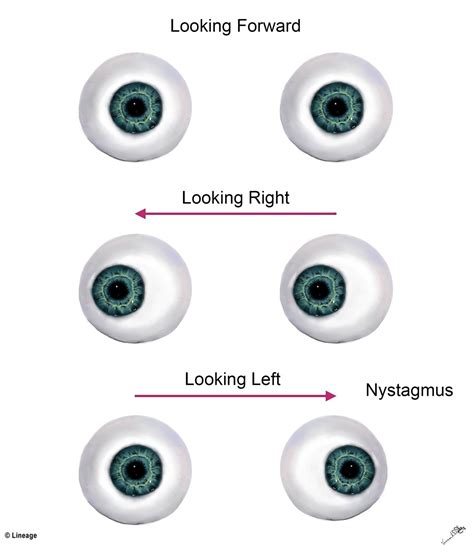 INTERNUCLEAR OPHTHALMOPLEGIA PDF