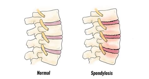 Spondylosis - Symptoms, Causes, Treatment and Rehabilitation