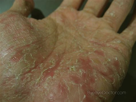 causes of dyshidrotic eczema - pictures, photos