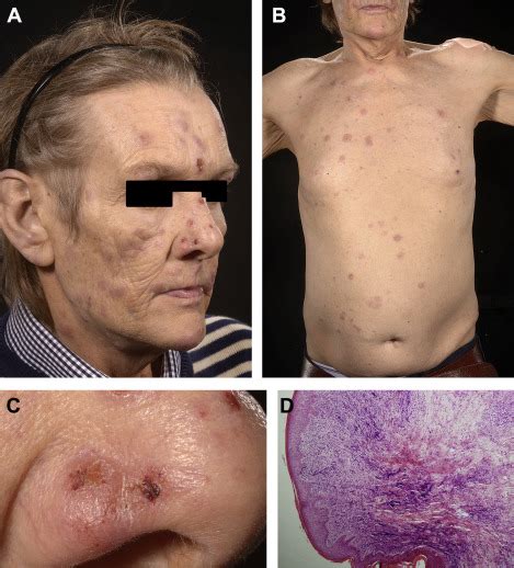 Regression of Paraneoplastic Rash after Lung Cancer Chemotherapy - Journal of Thoracic Oncology